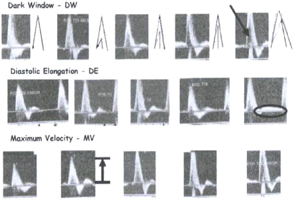 Figure 1  Schéma d’évaluation semi-quantitatif des paramètres vasculaires. [4]