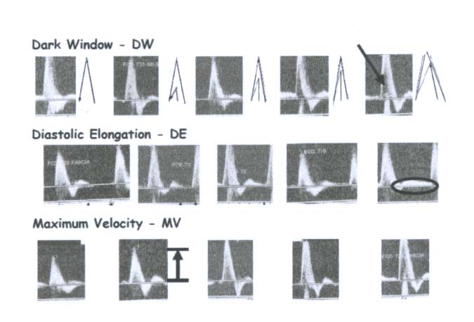 fig3-quere_classif echodoppler.jpg